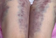 «Сепсис, заражение крови, некроз»: доктор-мясник из Махачкалы изуродовала более 20 девушек во время процедур по откачке жира