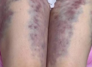 «Сепсис, заражение крови, некроз»: доктор-мясник из Махачкалы изуродовала более 20 девушек во время процедур по откачке жира